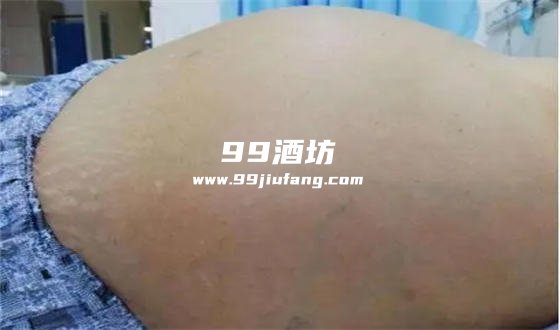 腹部积水可以喝白酒吗女性