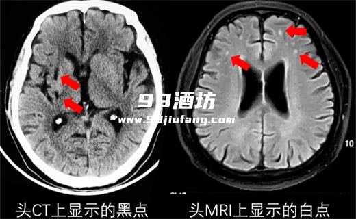 脑缺血灶能喝点白酒吗