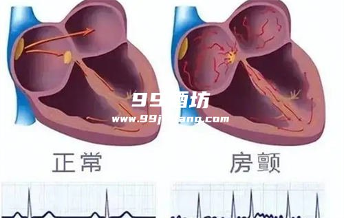 房颤可以少量饮用白酒吗